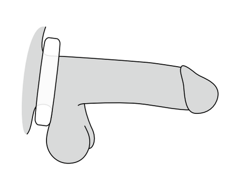 Medintim Backup Erection Ring