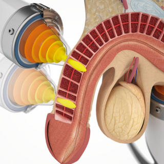 Handheld shockwave applicator delivering focused acoustic waves