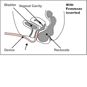 Femmeze® Vaginal Tool for Rectocele & Constipation